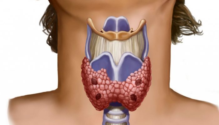 Чи може бути кашель при хворобі щитовидки? Симптоми і лікування