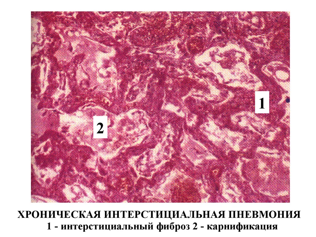 Пневмонія (патанатомією)