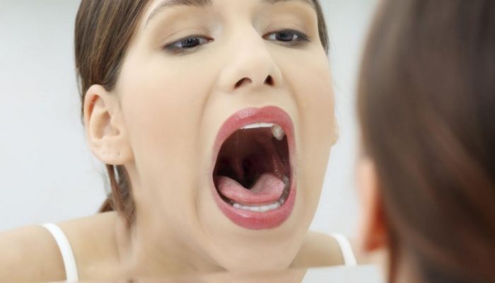 Як лікувати опік неба? Як лікувати опік неба?